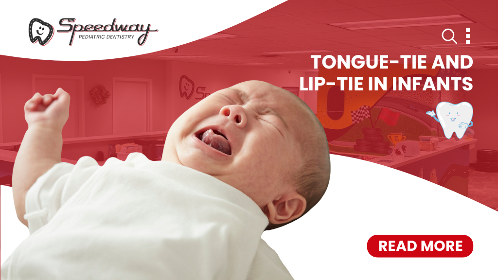 Tongue-Tie and Lip-Tie in Infants